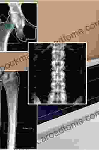 Osteoporosis And Bone Densitometry Measurements (Medical Radiology)